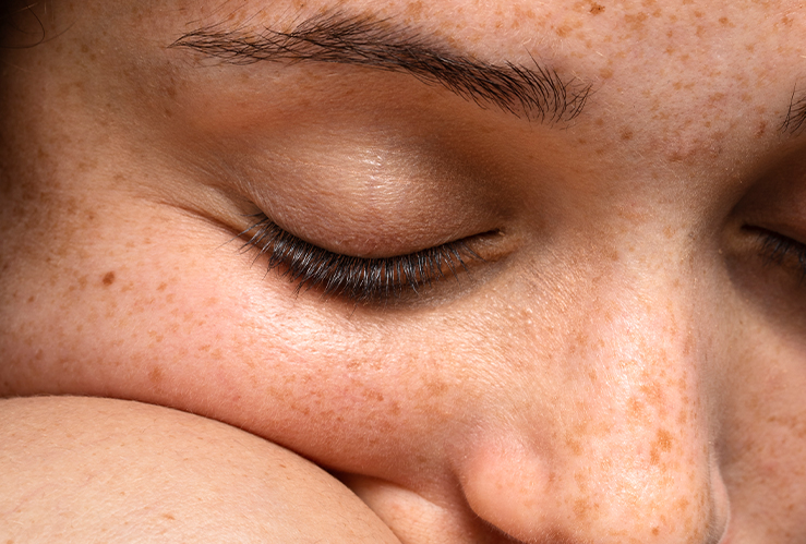 5 Astuces Incontournables pour Prévenir l&rsquo;Apparition des Taches Pigmentaires